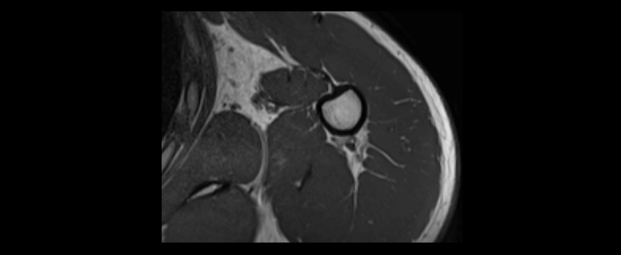 shoulder ligaments axial 3d 3t mri image-img-00005-00110.webp